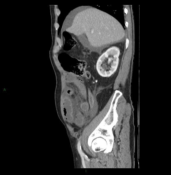 Closed loop small bowel obstruction with ischemia (Radiopaedia 84180-99456 C 26).jpg