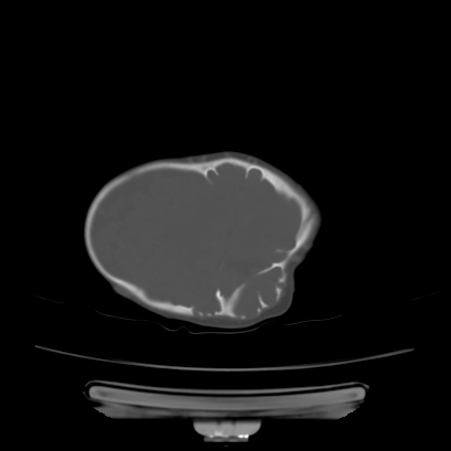 Cloverleaf skull (Radiopaedia 91901-109710 Axial bone window 124).jpg