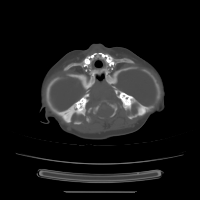 Cloverleaf skull (Radiopaedia 91901-109710 Axial bone window 45).jpg