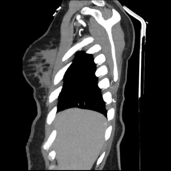 Coarctation of the aorta (Radiopaedia 67609-77010 C 58).jpg