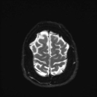 File:Cochlear incomplete partition type III associated with hypothalamic hamartoma (Radiopaedia 88756-105498 Axial DWI 37).jpg