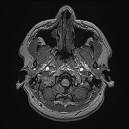 Cochlear incomplete partition type III associated with hypothalamic hamartoma (Radiopaedia 88756-105498 Axial T1 35).jpg