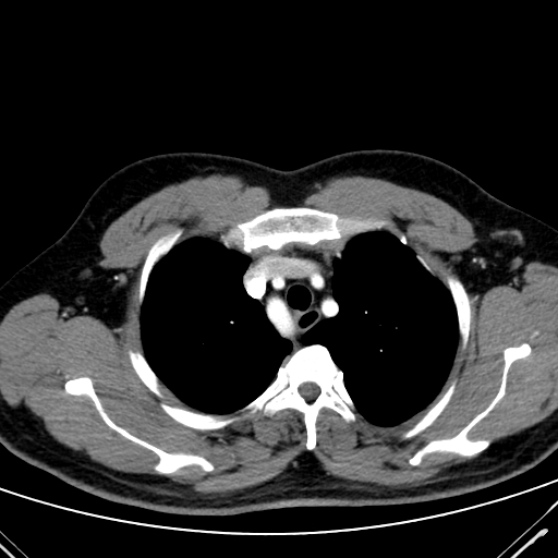 Codominant double aortic arch (Radiopaedia 56012-62637 A 16).jpg