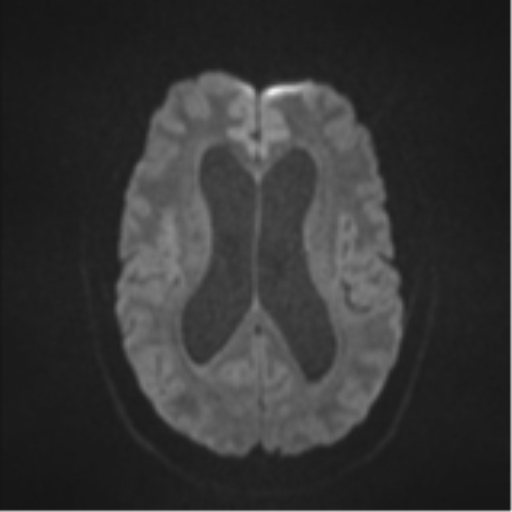 File:Colloid cyst (Radiopaedia 44510-48181 Axial DWI 44).png