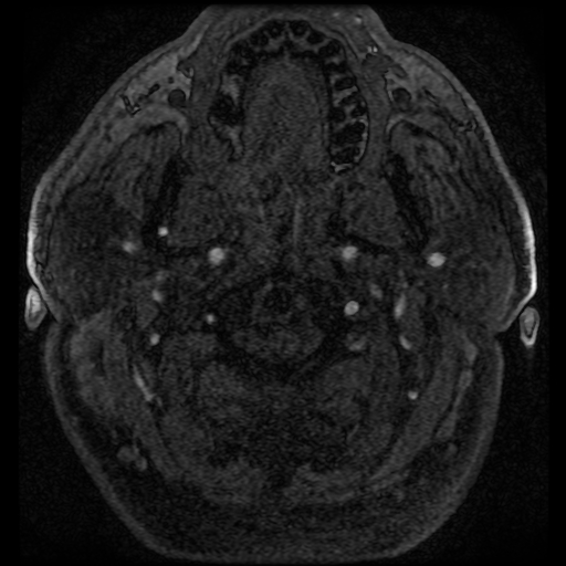 File:Colloid cyst with anterior communicating artery aneurysm (Radiopaedia 33901-35091 Axial MRA 10).jpg
