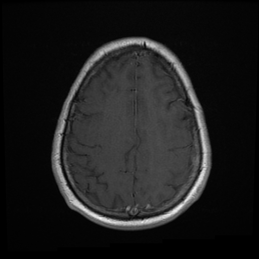 File:Colloid cyst with anterior communicating artery aneurysm (Radiopaedia 33901-35091 Axial T1 C+ 22).jpg
