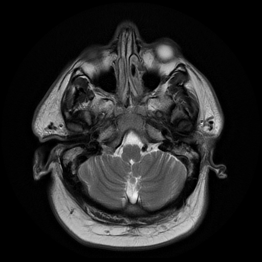 File:Colloid cyst with anterior communicating artery aneurysm (Radiopaedia 33901-35091 Axial T2 4).jpg