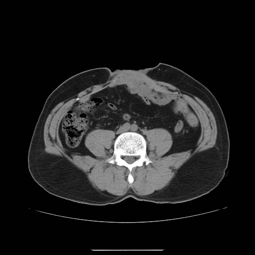 File:Colocutaneous fistula in Crohn's disease (Radiopaedia 29586-30093 Axial non-contrast 16).jpg