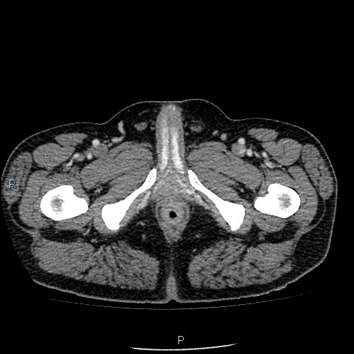 Colon adenocarcinoma with calcific liver metastasis (Radiopaedia 55745-62300 B 51).jpg
