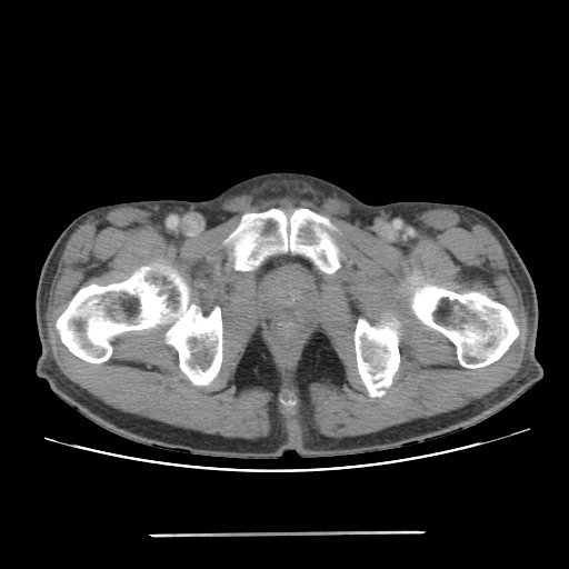 File:Colon cancer with calcified liver metastasis (Radiopaedia 74423-85307 A 78).jpg