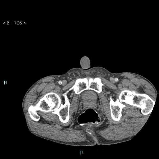 File:Colonic cancer (ultrasound and TC imaging) (Radiopaedia 50346-55713 A 150).jpg