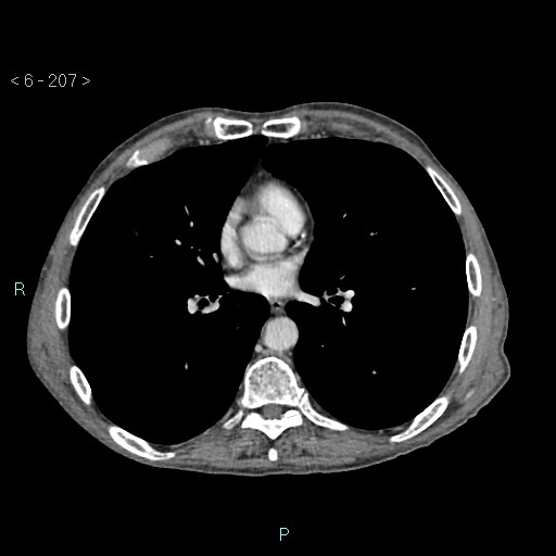 Colonic cancer (ultrasound and TC imaging) (Radiopaedia 50346-55713 B 207).jpg