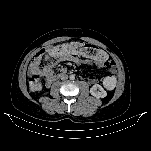 Colonic diverticulosis (Radiopaedia 72222-82744 A 14).jpg