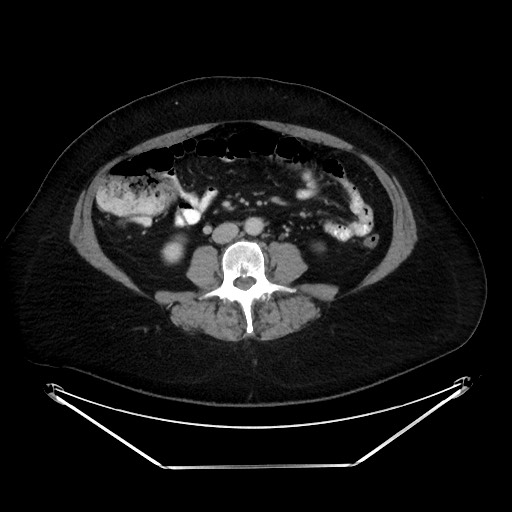 File:Colonic intussusception due to adenocarcinoma (Radiopaedia 86828-102987 A 83).jpg