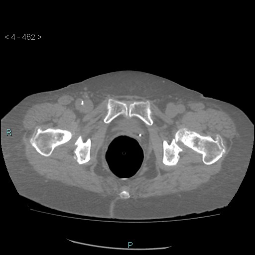 Colonic lipomas (Radiopaedia 49137-54244 Axial bone window 206).jpg