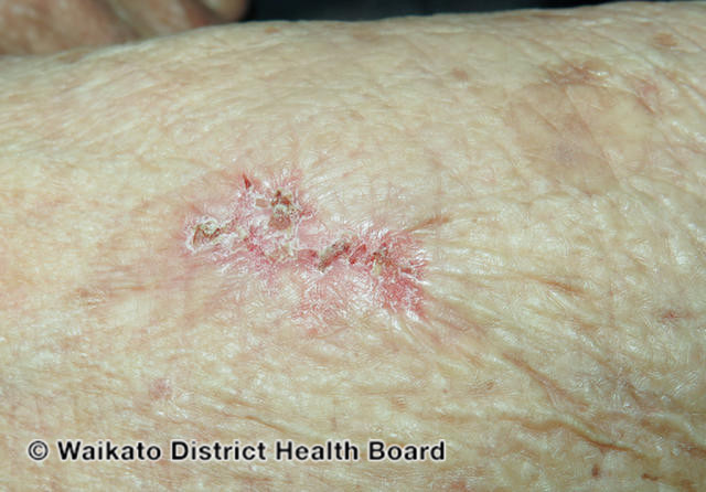 File:Eroding superficial basal cell carcinoma, arm (DermNet NZ esbcc-arm-13-wdhb-).jpg