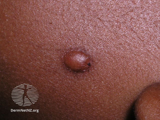File:Juvenile xanthogranuloma (DermNet NZ lesions-jxg4).jpg