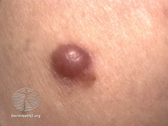 File:Macro image of amelanotic melanoma 1 (DermNet NZ amelanotic-melanoma-macro).jpg
