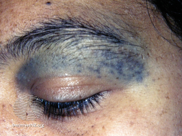 File:Naevus of Ota (DermNet NZ lesions-ota).jpg