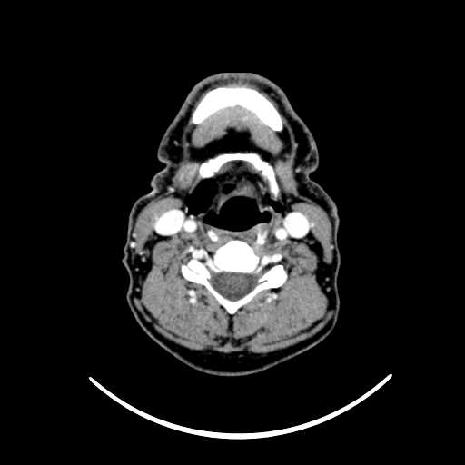File:Nasopharyngeal carcinoma - infiltrating the clivus (Radiopaedia 62583-70875 Axial Post contrast 46).jpg