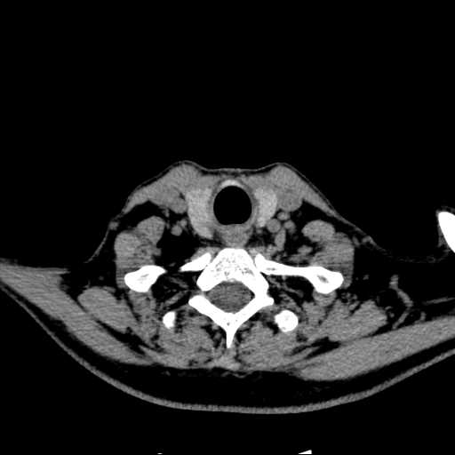 File:Nasopharyngeal carcinoma - infiltrating the clivus (Radiopaedia 62583-70875 Axial non-contrast 60).jpg