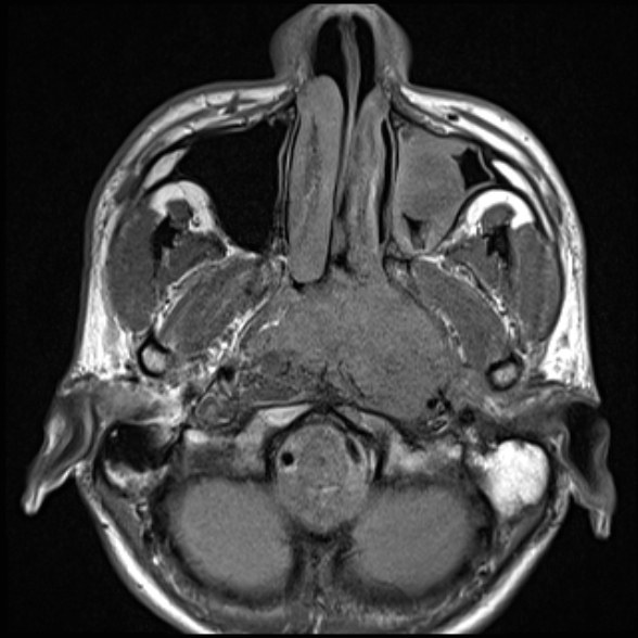 Nasopharyngeal carcinoma with skull base invasion (Radiopaedia 53415-59485 Axial T1 28).jpg