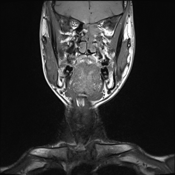 Nasopharyngeal carcinoma with skull base invasion (Radiopaedia 53415-59485 Coronal T1 28).jpg
