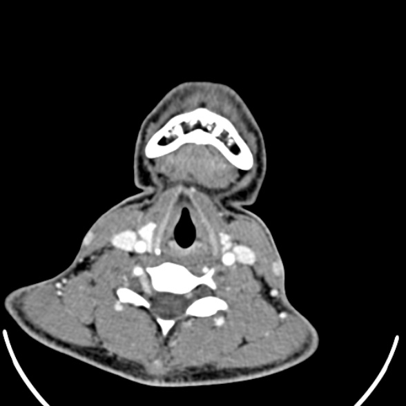 File:Nasopharyngeal carcinoma with skull base invasion (Radiopaedia 53415-59705 A 150).jpg