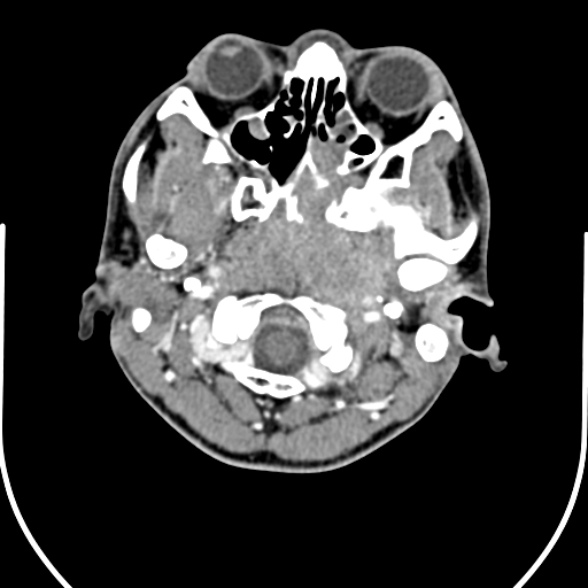 Nasopharyngeal carcinoma with skull base invasion (Radiopaedia 53415-59705 A 33).jpg