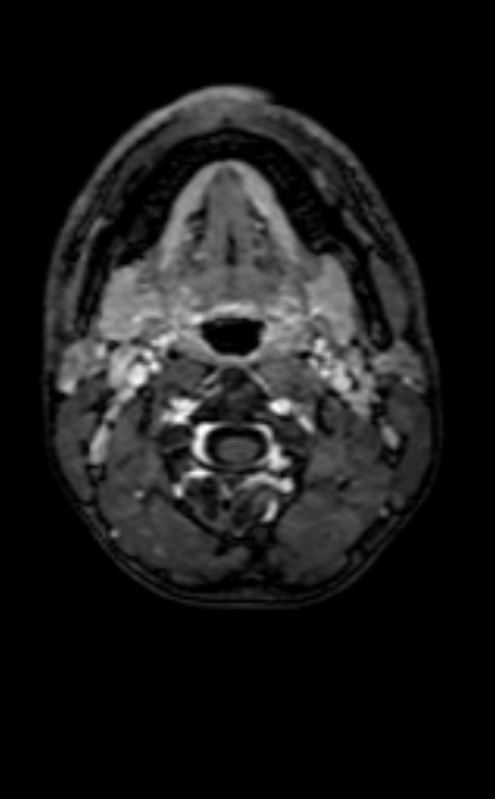 Neuro-Behçet disease (Radiopaedia 90112-107294 Axial T1 C+ 243).jpg