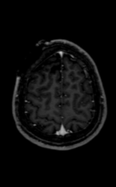 Neuro-Behçet disease (Radiopaedia 90112-107294 Axial T1 C+ 71).jpg