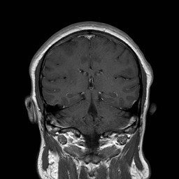 File:Neuro-Behcet's disease (Radiopaedia 21557-21505 Coronal T1 C+ 13).jpg