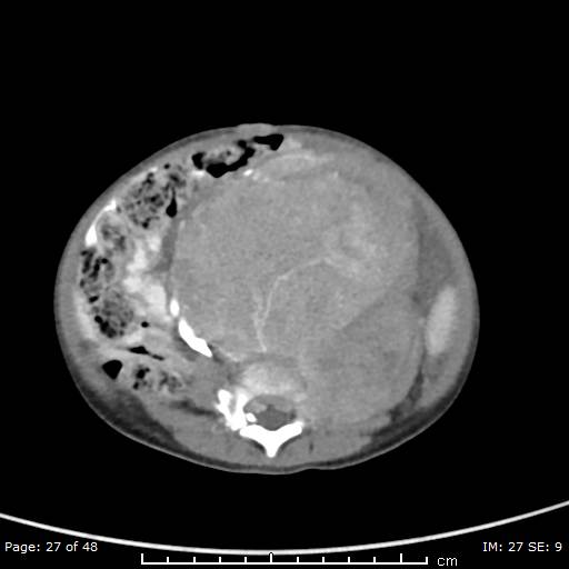 File:Neuroblastoma (Radiopaedia 41472-44355 A 27).jpg