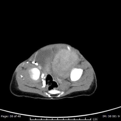 File:Neuroblastoma (Radiopaedia 41472-44355 A 38).jpg