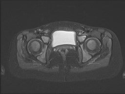 File:Neuroblastoma with bone metastases (Radiopaedia 67080-76414 Axial STIR 48).jpg