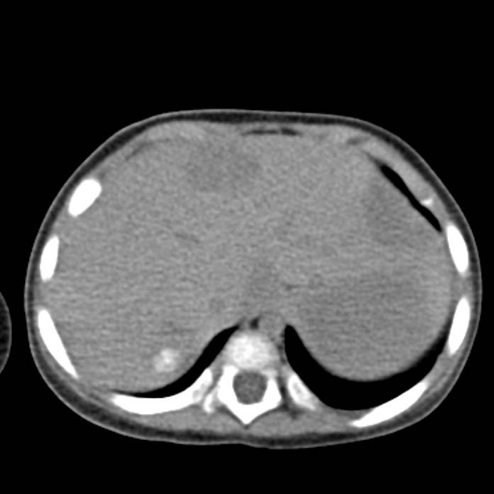 Neuroblastoma with skull metastases (Radiopaedia 30326-30960 Axial non-contrast 8).jpg