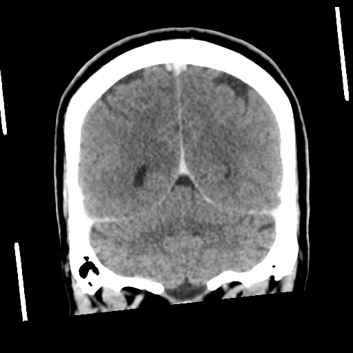 Neurocysticercosis - granular nodular (Radiopaedia 42786-45957 Coronal C+ 48).png