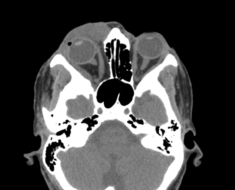Neurofibromatosis type 1- orbital manifestations (Radiopaedia 49391-54511 Axial non-contrast 47).jpg