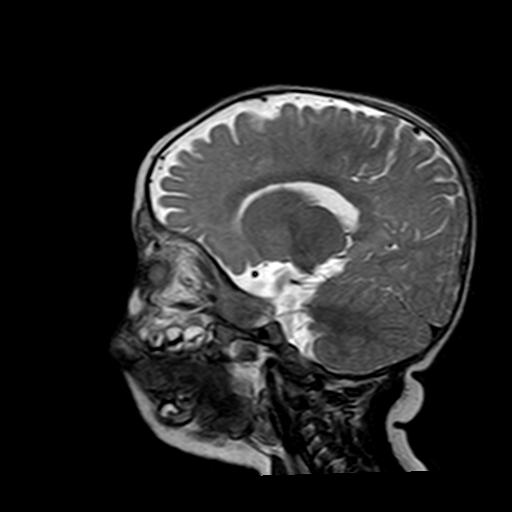 File:Neurofibromatosis type 1 (Radiopaedia 30089-30671 Sagittal T2 12).jpg