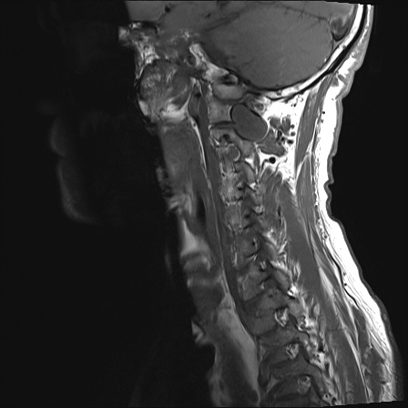 File:Neurofibromatosis type 1 (Radiopaedia 80355-93740 Sagittal T1 1).jpg