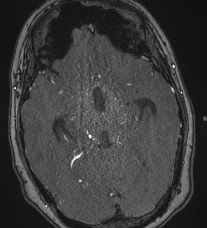 Neurofibromatosis type 1 - head and neck - CNS manifestations (Radiopaedia 49910-55188 Axial MRA 35).png