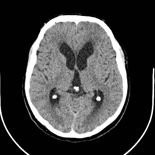 Neurofibromatosis type 2 (Radiopaedia 79097-92047 Axial non-contrast 30).jpg