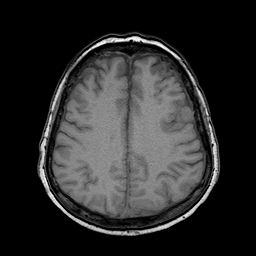 File:Neurofibromatosis type 2 (Radiopaedia 8713-9518 Axial T1 8).jpg