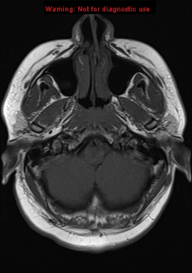 File:Neuroglial cyst (Radiopaedia 10713-11184 Axial T1 20).jpg