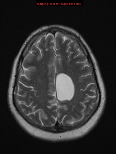 File:Neuroglial cyst (Radiopaedia 10713-11184 Axial T2 6).jpg