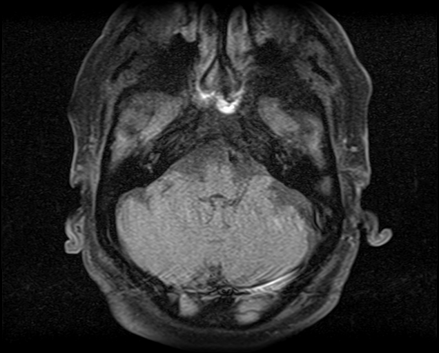 File:Non-Hodgkin lymphoma - parotid gland (Radiopaedia 71531-81890 T1 fat sat 22).jpg