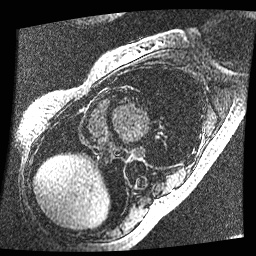 File:Non-compaction of the left ventricle (Radiopaedia 38868-41062 E 12).jpg