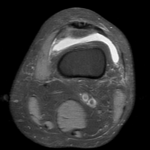 File:Non-displaced patella fracture (Radiopaedia 15932-15582 Axial PD fat sat 3).jpg