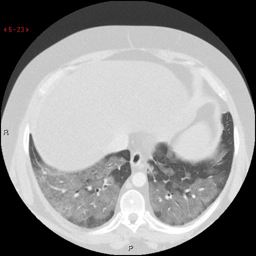 File:Non-specific interstitial pneumonitis (Radiopaedia 27044-27222 Axial lung window 14).jpg