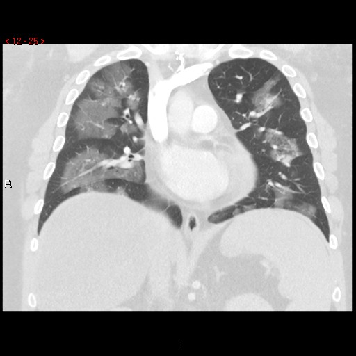 File:Non-specific interstitial pneumonitis (Radiopaedia 27044-27222 Coronal lung window 25).jpg